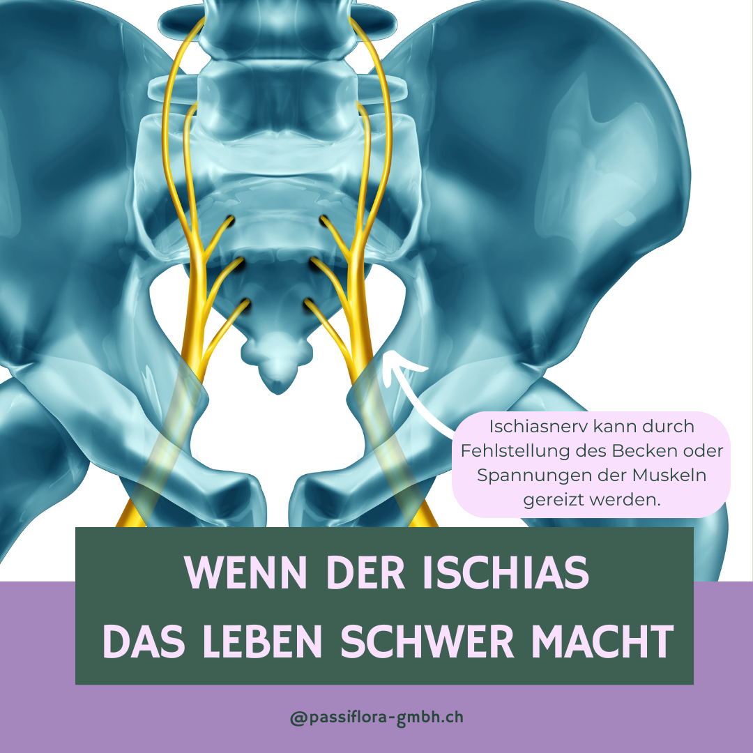 Ischiasschmerzen oder Ischias